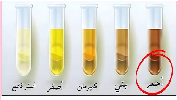 لون البول يكشف عن حالتك الصحية تعرف إذا كنت خاليا من الأمــراض أو تحتاج ...